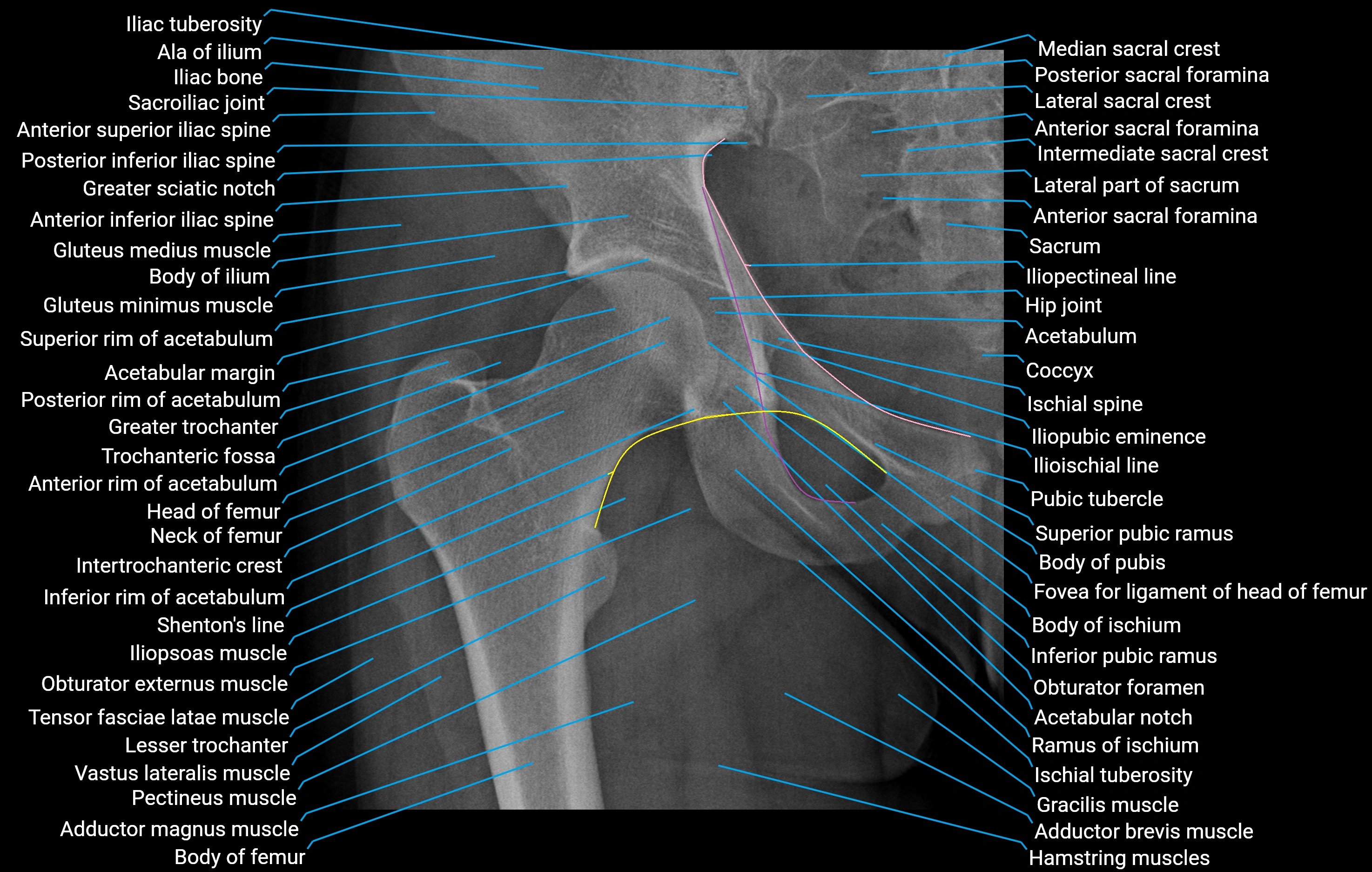 x ray Hip AP anatomy.webp